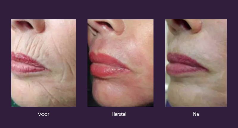 Fenol-voor-herstel-na